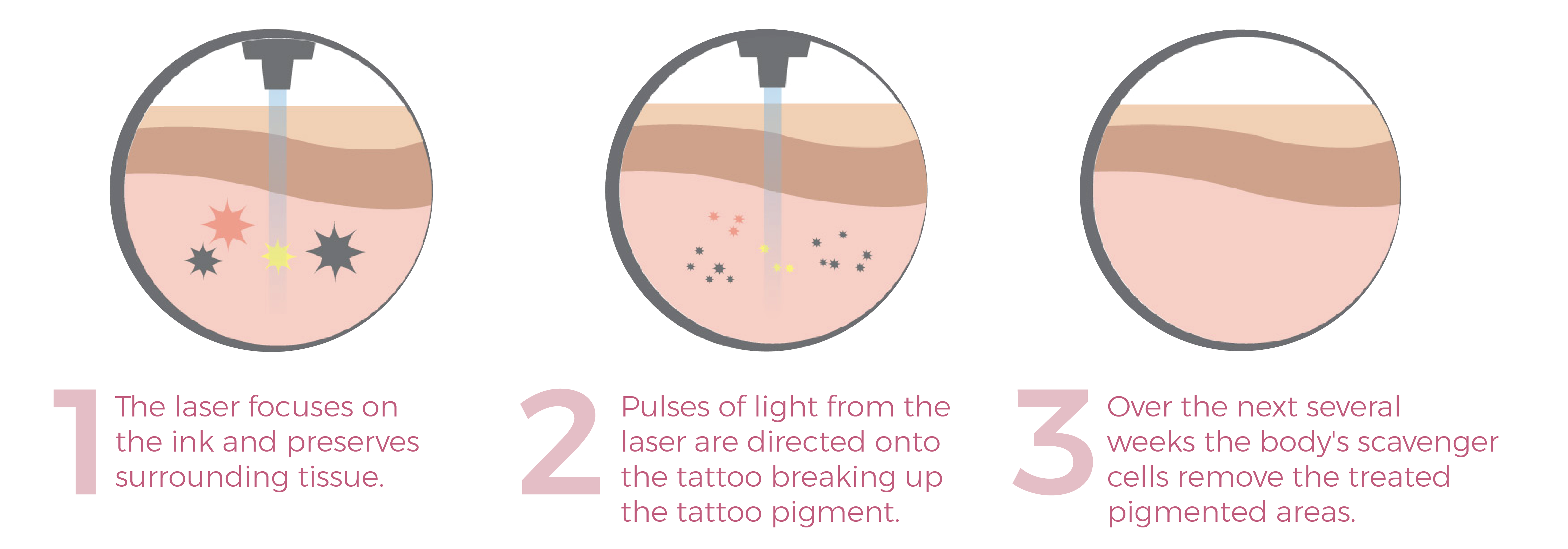 Tattoo Removal 